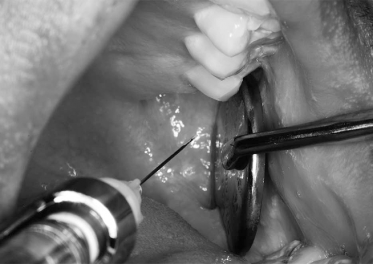 Delivery of mandibular block injection using modified retraction technique.