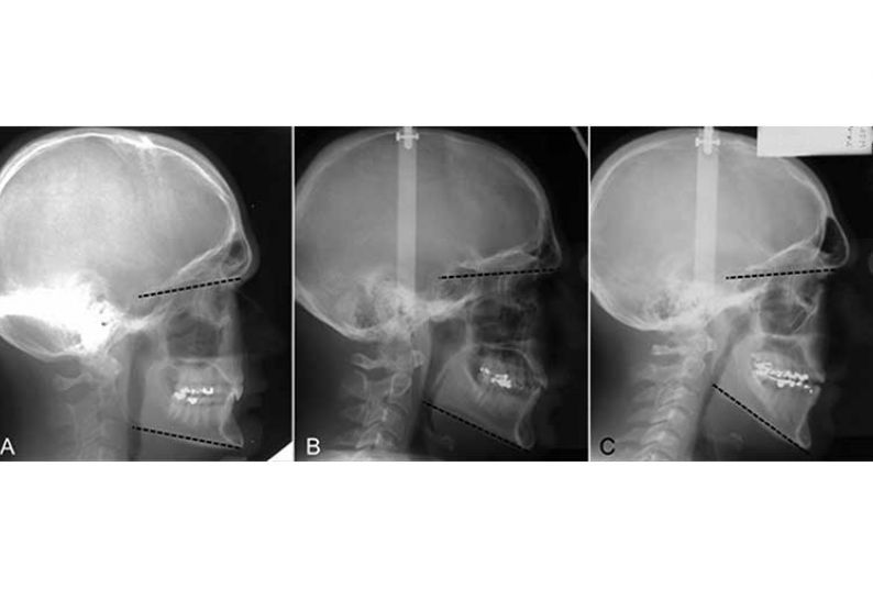 Lateral cephalograms demonstrating examples of hypo‐divergent (A), normo‐divergent (B) and hyper‐divergent (C) facial types.